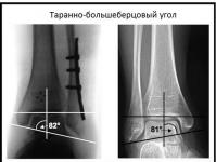 Ankle fracture: symptoms and treatment
