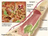 Osteomyelitis ni nini na jinsi ya kutibu?