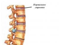 Знаци на остеохондроза во цервикалниот, торакалниот и лумбалниот 'рбет кај мажи или жени